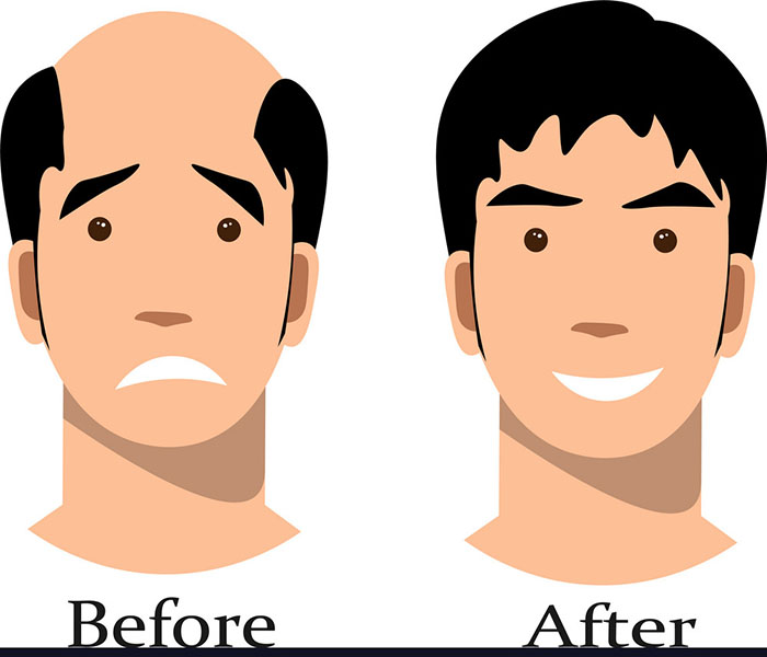 Male Pattern Baldness