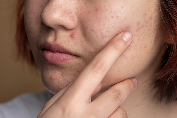 Does Tretinoin Cream Help with Acne Scars