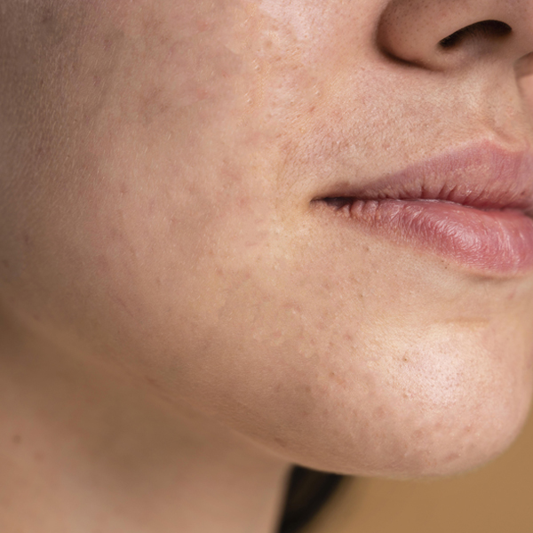 acne (1) acne (1)