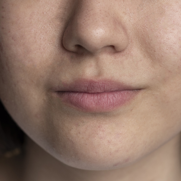 acne2 acne2