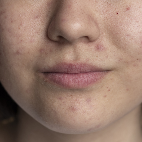acne2_before acne2_before