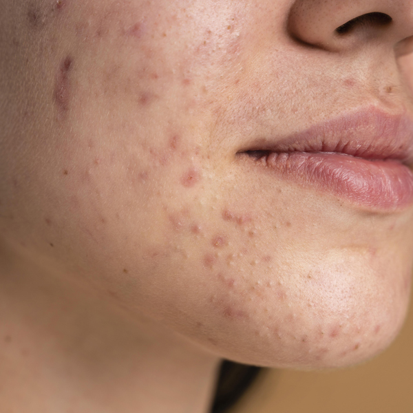 acne_before acne_before